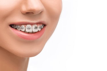 The Psychological Impact of Braces: Boosting Self-Confidence and Body Positivity
